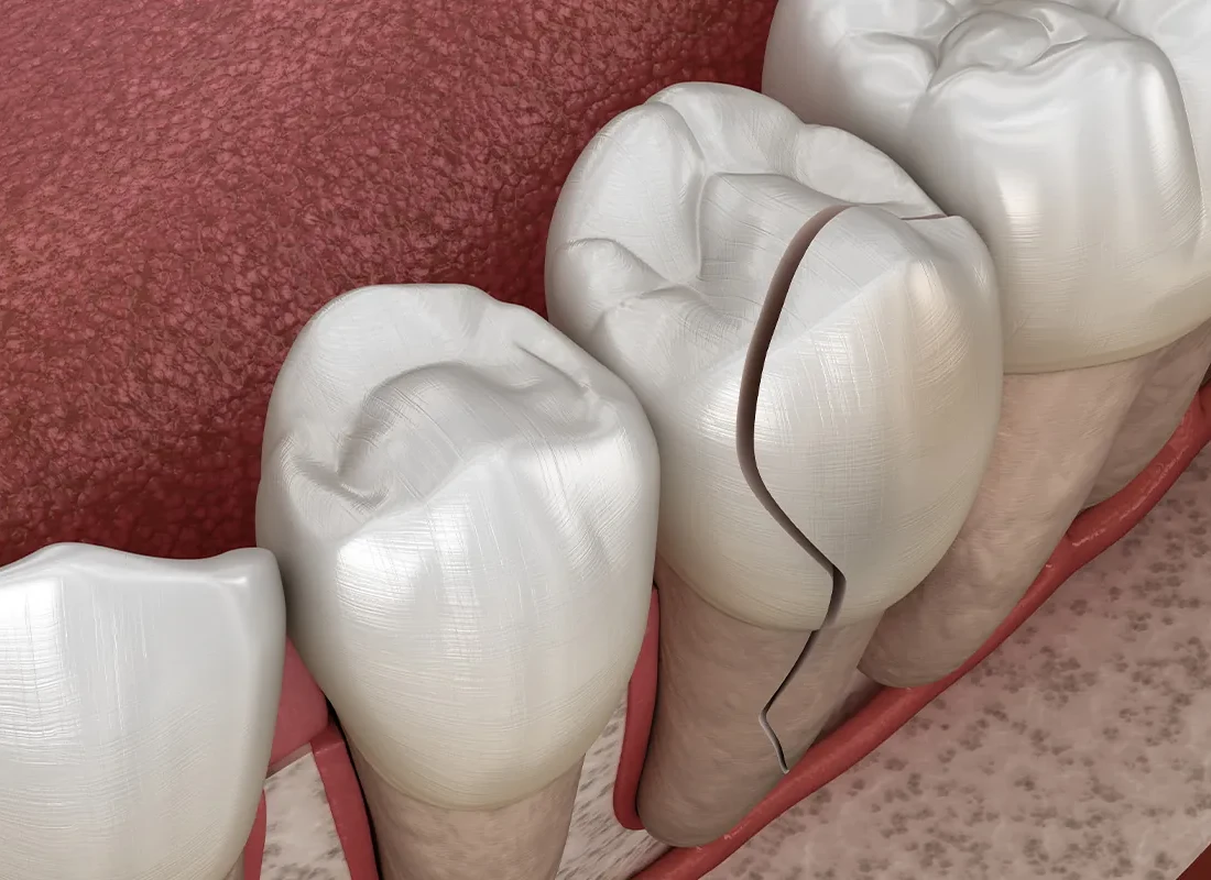 chipped tooth